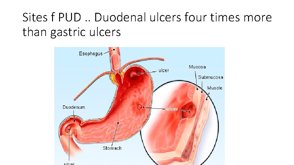 Sites f PUD. . Duodenal ulcers four times more than gastric ulcers 