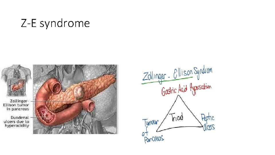 Z-E syndrome 