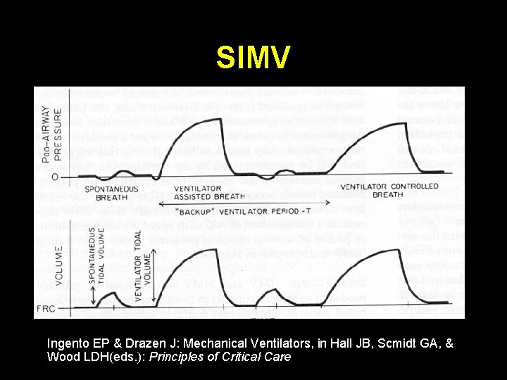 SIMV Ingento EP & Drazen J: Mechanical Ventilators, in Hall JB, Scmidt GA, &