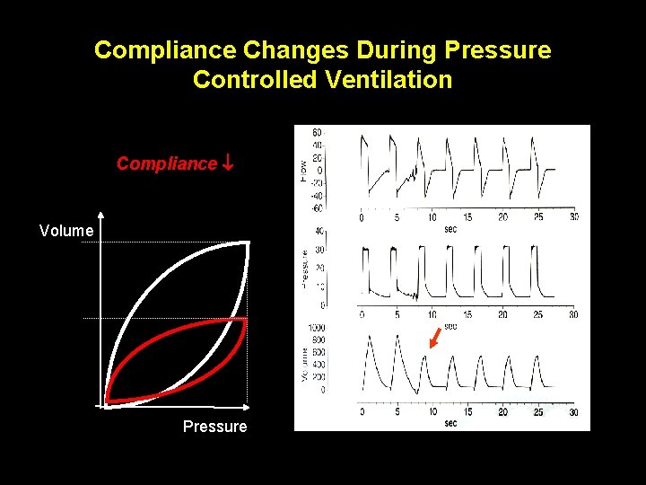 Compliance Changes During Pressure Controlled Ventilation Compliance Volume Pressure 