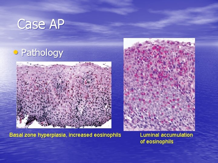 Case AP • Pathology Basal zone hyperplasia, increased eosinophils Luminal accumulation of eosinophils Case AP • Pathology Basal zone hyperplasia, increased eosinophils Luminal accumulation of eosinophils
