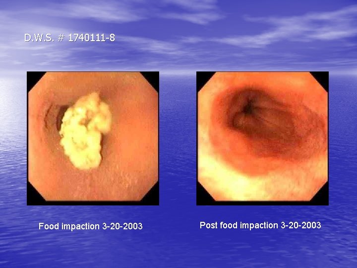 D. W. S. # 1740111 -8 Food impaction 3 -20 -2003 Post food impaction D. W. S. # 1740111 -8 Food impaction 3 -20 -2003 Post food impaction