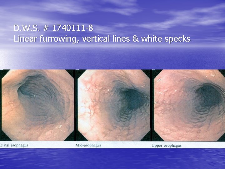 D. W. S. # 1740111 -8 Linear furrowing, vertical lines & white specks D. W. S. # 1740111 -8 Linear furrowing, vertical lines & white specks