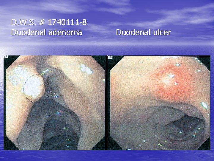 D. W. S. # 1740111 -8 Duodenal adenoma Duodenal ulcer D. W. S. # 1740111 -8 Duodenal adenoma Duodenal ulcer