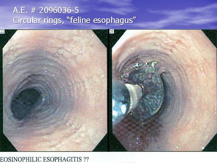 A. E. # 2096036 -5 Circular rings, “feline esophagus” A. E. # 2096036 -5 Circular rings, “feline esophagus”
