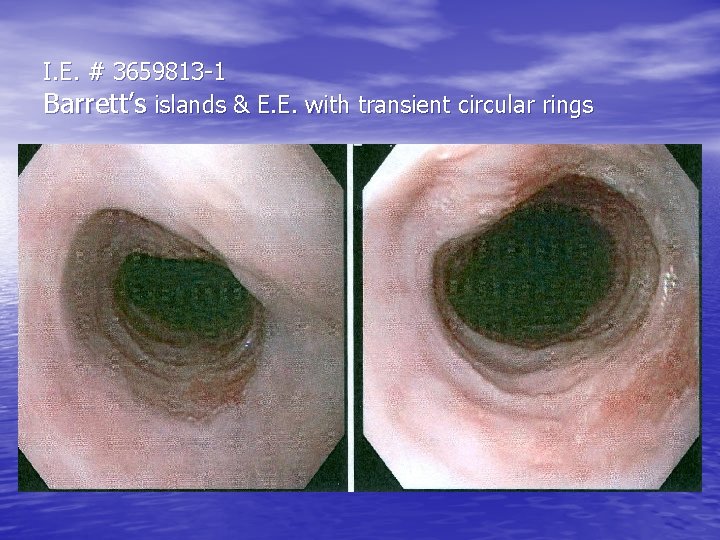 I. E. # 3659813 -1 Barrett’s islands & E. E. with transient circular rings I. E. # 3659813 -1 Barrett’s islands & E. E. with transient circular rings