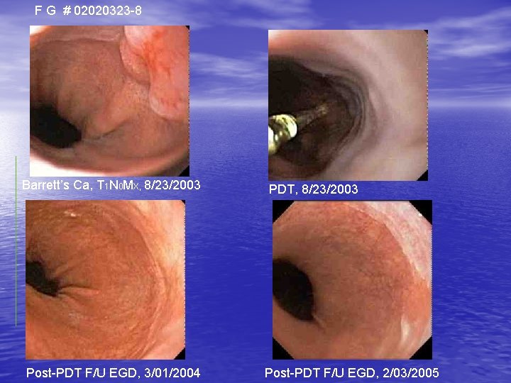 F G # 02020323 -8 Barrett’s Ca, T 1 N 0 MX, 8/23/2003 Post-PDT F G # 02020323 -8 Barrett’s Ca, T 1 N 0 MX, 8/23/2003 Post-PDT