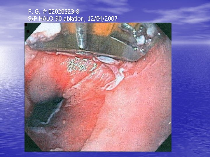 F. G. # 02020323 -8 S/P HALO-90 ablation, 12/04/2007 F. G. # 02020323 -8 S/P HALO-90 ablation, 12/04/2007