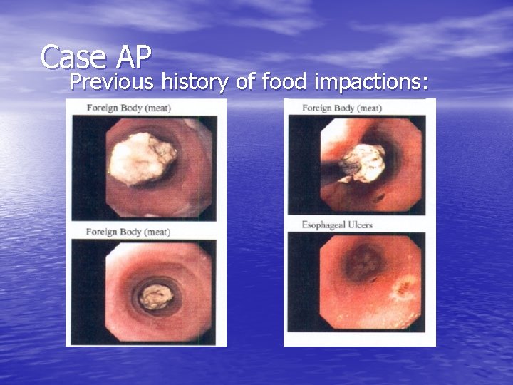 Case AP Previous history of food impactions: Case AP Previous history of food impactions: