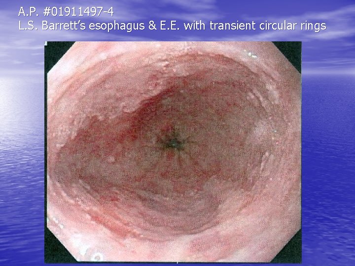 A. P. #01911497 -4 L. S. Barrett’s esophagus & E. E. with transient circular A. P. #01911497 -4 L. S. Barrett’s esophagus & E. E. with transient circular