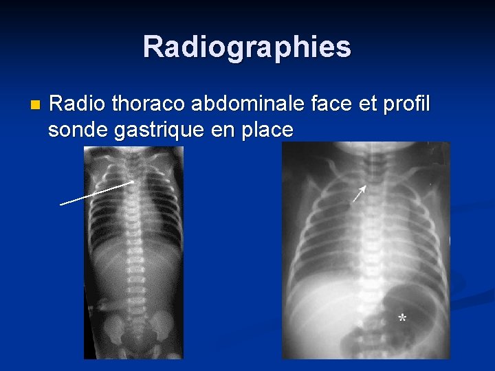 Radiographies n Radio thoraco abdominale face et profil sonde gastrique en place 