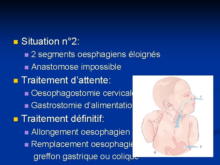 n Situation n° 2: 2 segments oesphagiens éloignés n Anastomose impossible n n Traitement