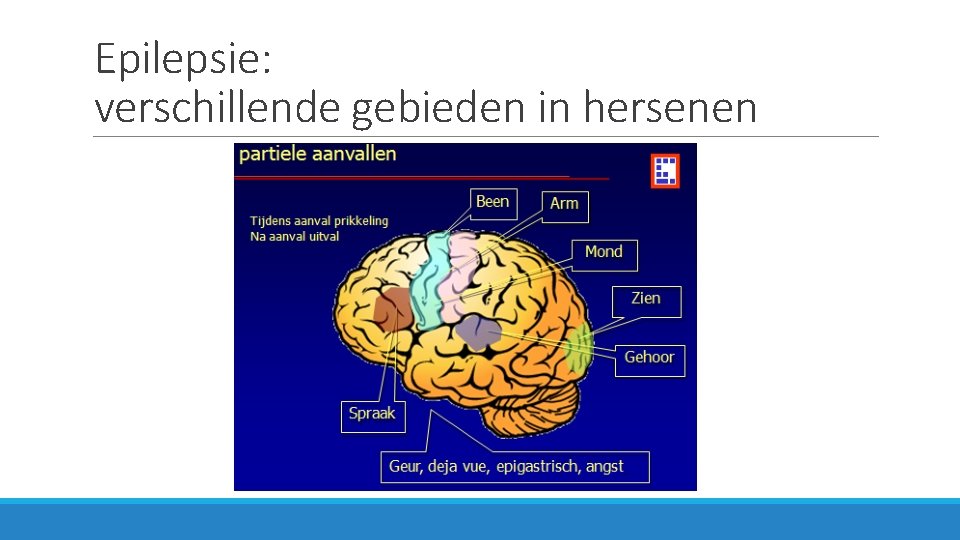 Epilepsie: verschillende gebieden in hersenen 