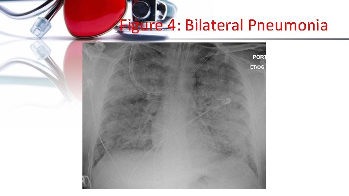 Figure 4: Bilateral Pneumonia 