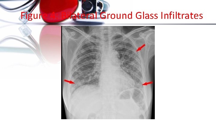 Figure 4: Bilateral Ground Glass Infiltrates 