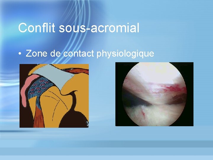 Conflit sous-acromial • Zone de contact physiologique 