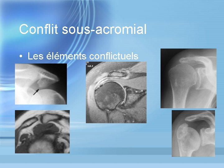 Conflit sous-acromial • Les éléments conflictuels 