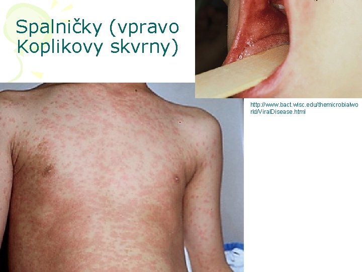 Spalničky (vpravo Koplikovy skvrny) http: //www. bact. wisc. edu/themicrobialwo rld/Viral. Disease. html 