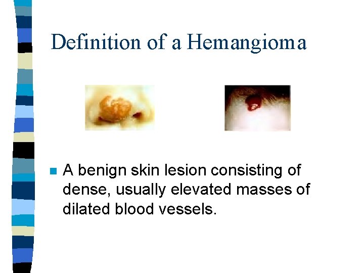 Definition of a Hemangioma n A benign skin lesion consisting of dense, usually elevated Definition of a Hemangioma n A benign skin lesion consisting of dense, usually elevated