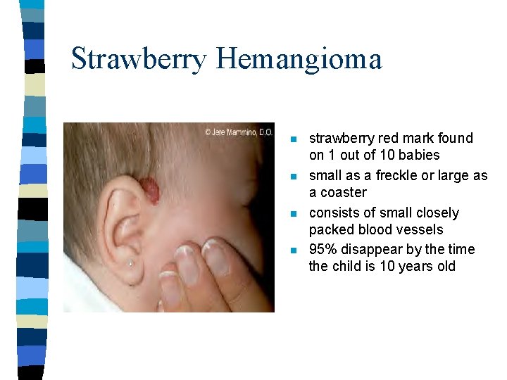 Strawberry Hemangioma n n strawberry red mark found on 1 out of 10 babies Strawberry Hemangioma n n strawberry red mark found on 1 out of 10 babies