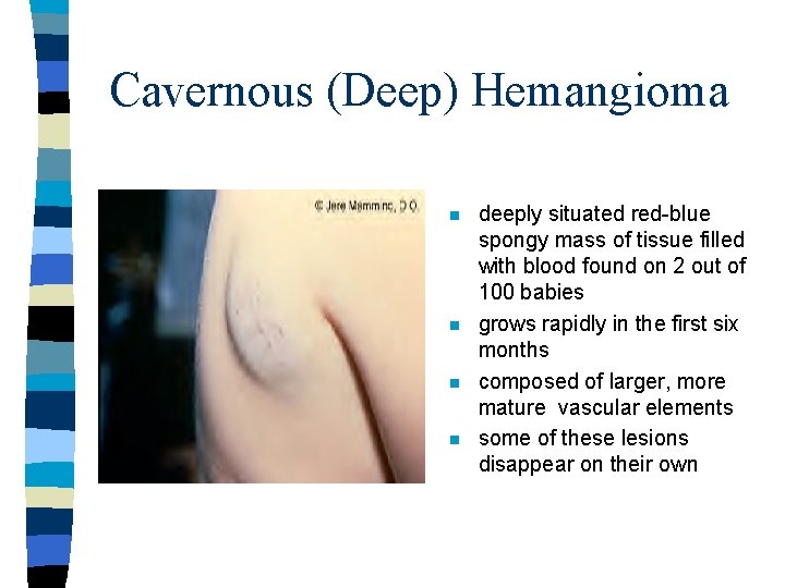 Cavernous (Deep) Hemangioma n n deeply situated red-blue spongy mass of tissue filled with Cavernous (Deep) Hemangioma n n deeply situated red-blue spongy mass of tissue filled with