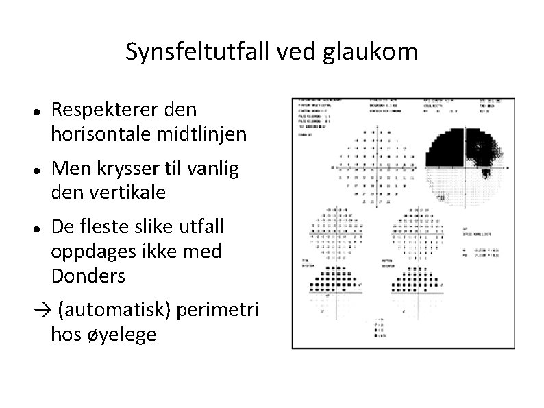 Synsfeltutfall ved glaukom Respekterer den horisontale midtlinjen Men krysser til vanlig den vertikale De