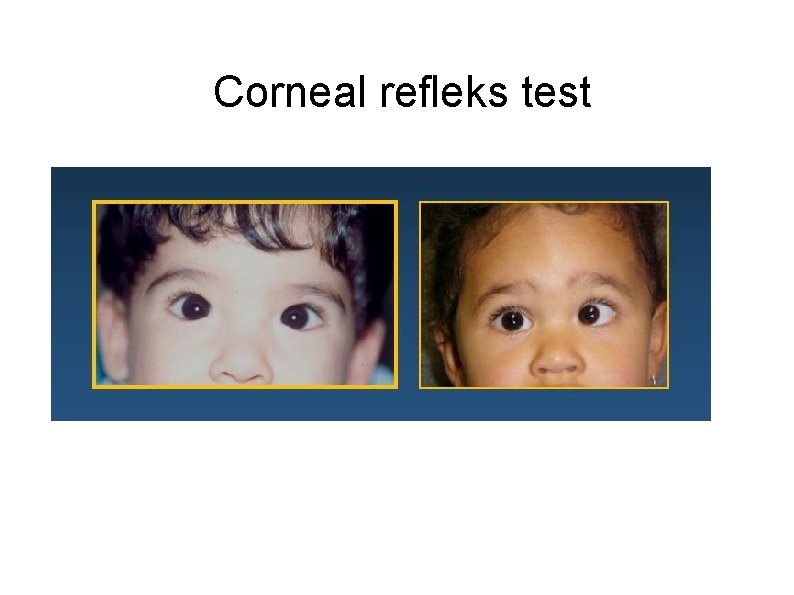 Corneal refleks test 