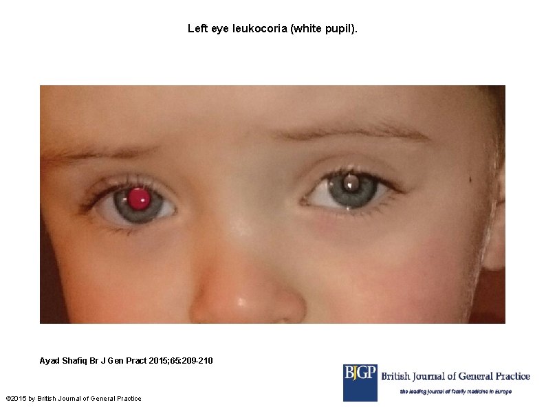 Left eye leukocoria (white pupil). Ayad Shafiq Br J Gen Pract 2015; 65: 209