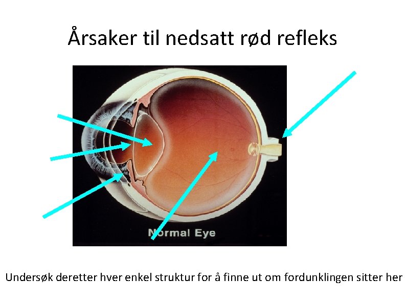 Årsaker til nedsatt rød refleks Undersøk deretter hver enkel struktur for å finne ut