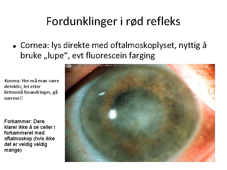 Fordunklinger i rød refleks Cornea: lys direkte med oftalmoskoplyset, nyttig å bruke „lupe“, evt