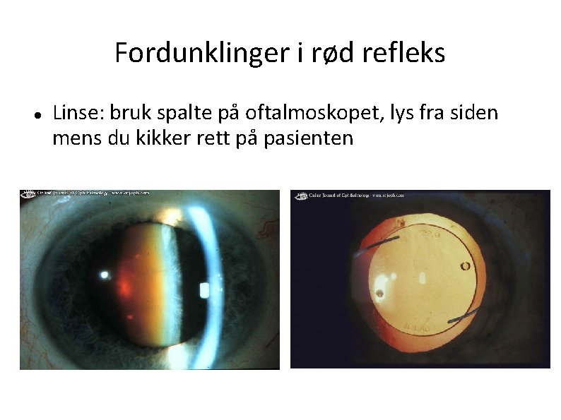 Fordunklinger i rød refleks Linse: bruk spalte på oftalmoskopet, lys fra siden mens du