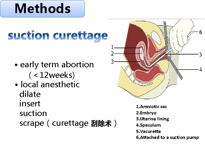 Methods · early term abortion (＜ 12 weeks) · local anesthetic dilate insert suction