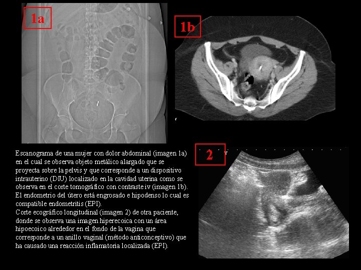 1 a 1 b Escanograma de una mujer con dolor abdominal (imagen 1 a) 1 a 1 b Escanograma de una mujer con dolor abdominal (imagen 1 a)