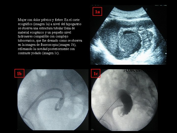 1 a Mujer con dolor pélvico y fiebre. En el corte ecográfico (imagen 1 1 a Mujer con dolor pélvico y fiebre. En el corte ecográfico (imagen 1