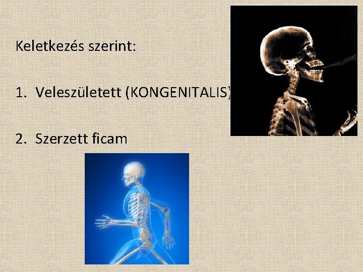 Keletkezés szerint: 1. Veleszületett (KONGENITALIS) 2. Szerzett ficam 
