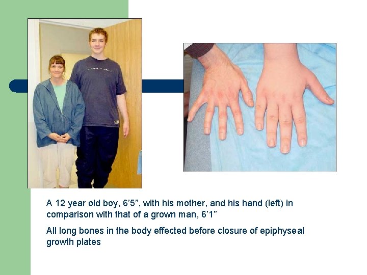 A 12 year old boy, 6’ 5”, with his mother, and his hand (left)