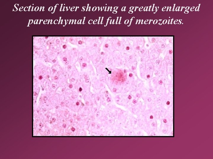 Section of liver showing a greatly enlarged parenchymal cell full of merozoites. 