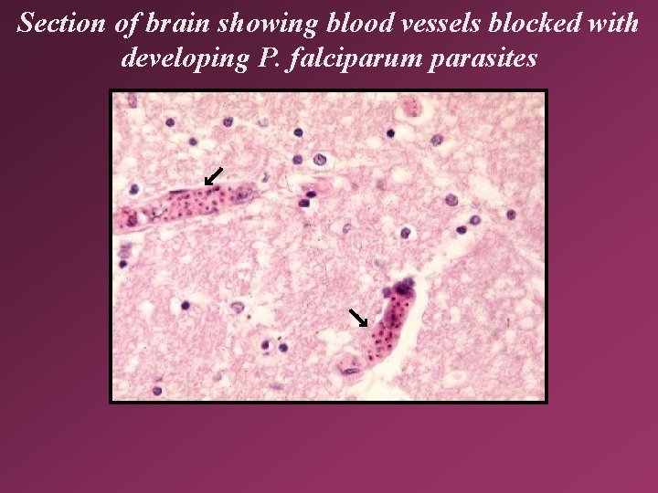 Section of brain showing blood vessels blocked with developing P. falciparum parasites 