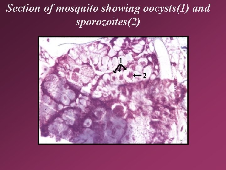 Section of mosquito showing oocysts(1) and sporozoites(2) 