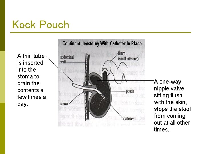 Kock Pouch A thin tube is inserted into the stoma to drain the contents