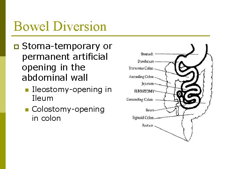 Bowel Diversion p Stoma-temporary or permanent artificial opening in the abdominal wall n n