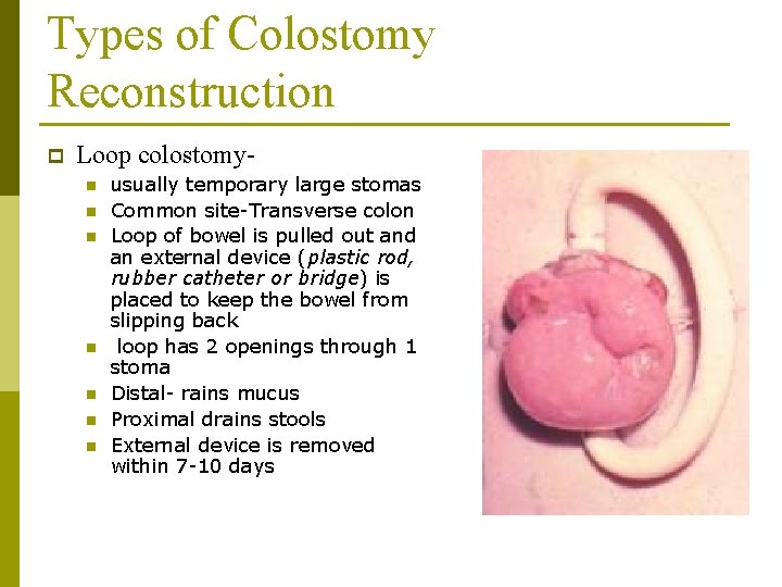 Types of Colostomy Reconstruction p Loop colostomyn n n n usually temporary large stomas