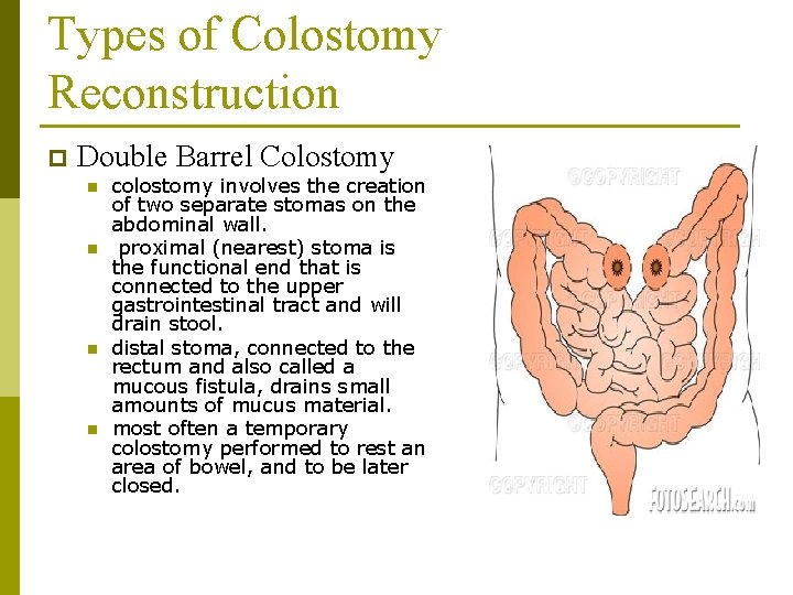 Types of Colostomy Reconstruction p Double Barrel Colostomy n n colostomy involves the creation