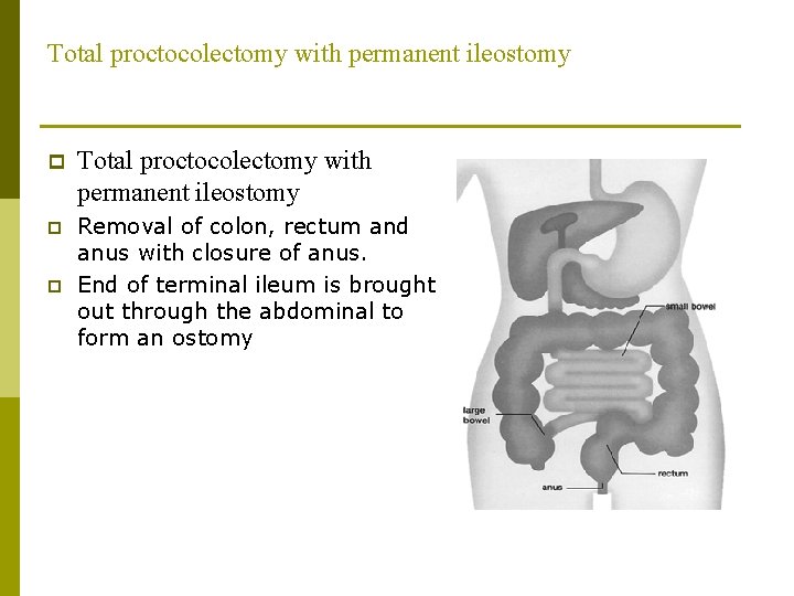 Total proctocolectomy with permanent ileostomy p Removal of colon, rectum and anus with closure