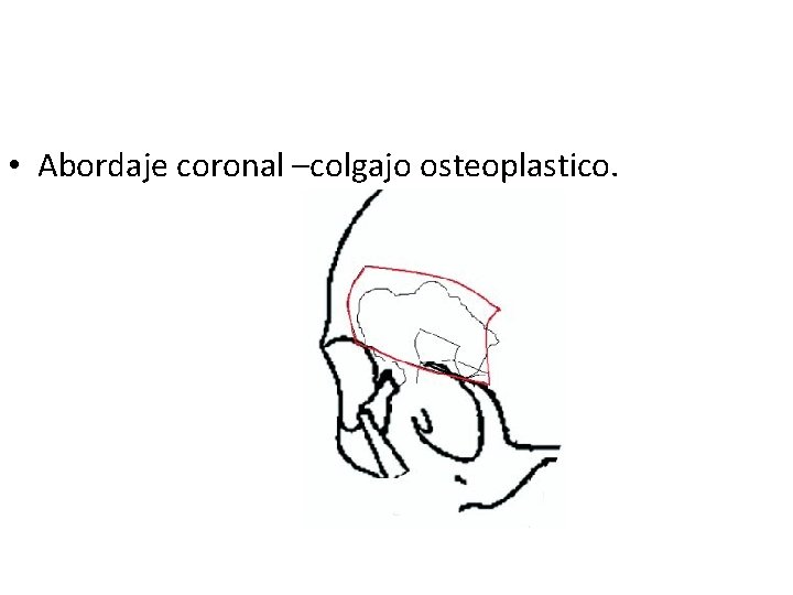  • Abordaje coronal –colgajo osteoplastico. 