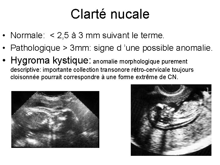 Clarté nucale • Normale: < 2, 5 à 3 mm suivant le terme. •