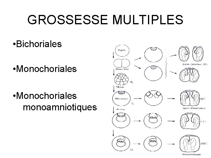 GROSSESSE MULTIPLES • Bichoriales • Monochoriales monoamniotiques biamniotiques 