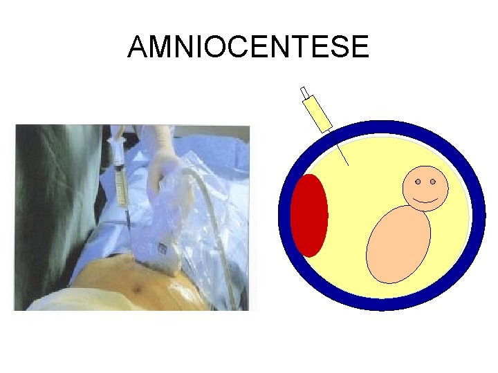 AMNIOCENTESE 