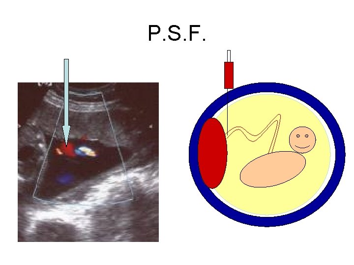 P. S. F. 