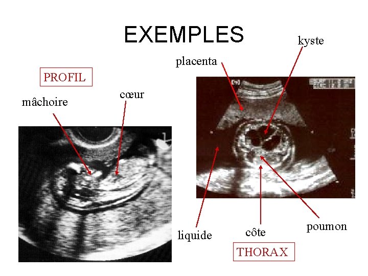 EXEMPLES kyste placenta PROFIL mâchoire cœur liquide côte THORAX poumon 